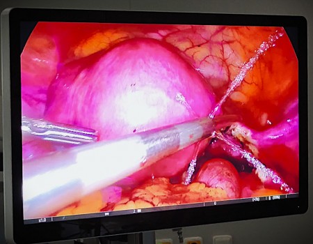 Foto: Bojnická nemocnica má novú endoskopicko-laparoskopickú zostavu najnovšej generácie. NAJMODERNEJŠIA TECHNIKA NIELEN PRE GYNEKOLOGICKÉ OPERÁCIE 6